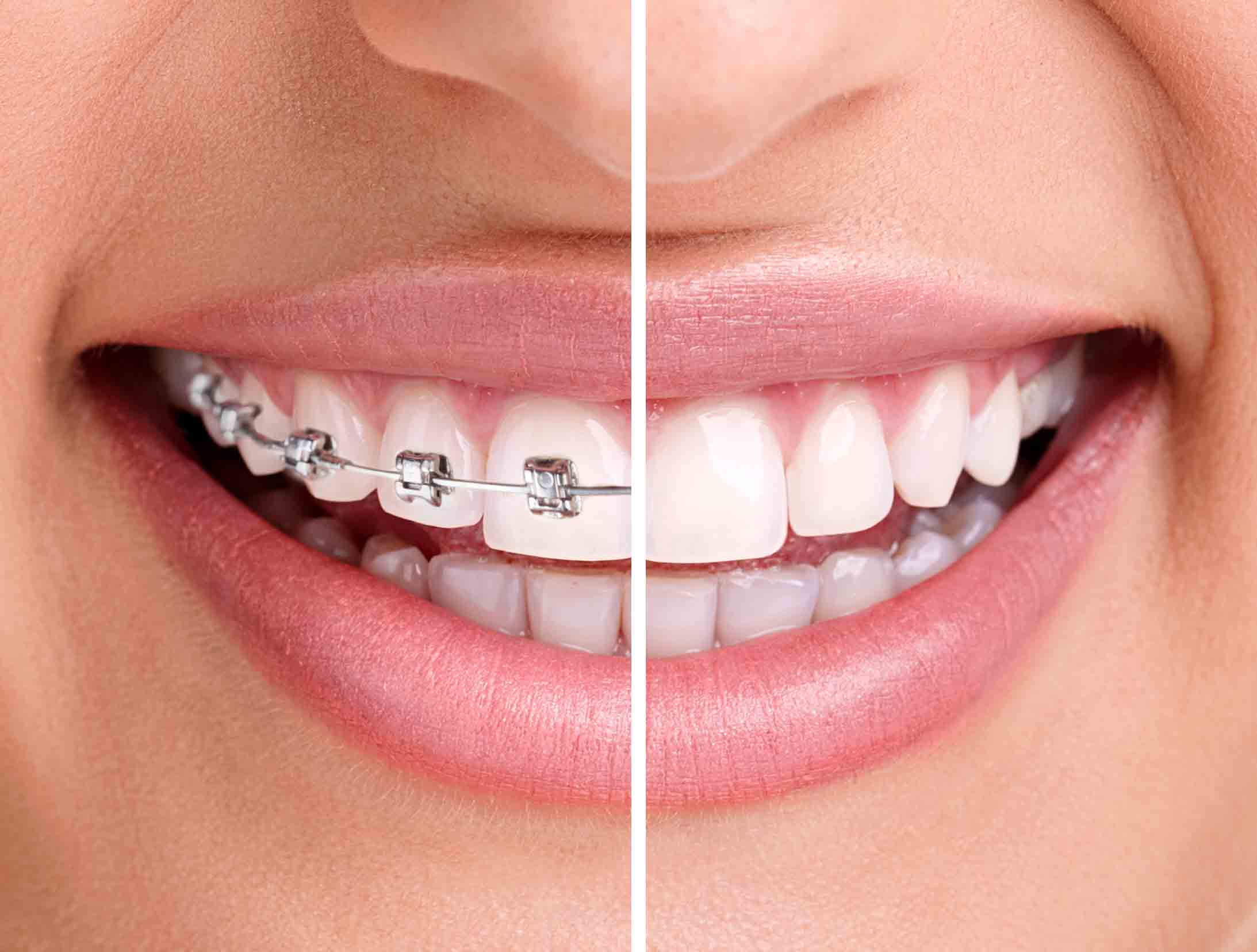 Early orthodontics