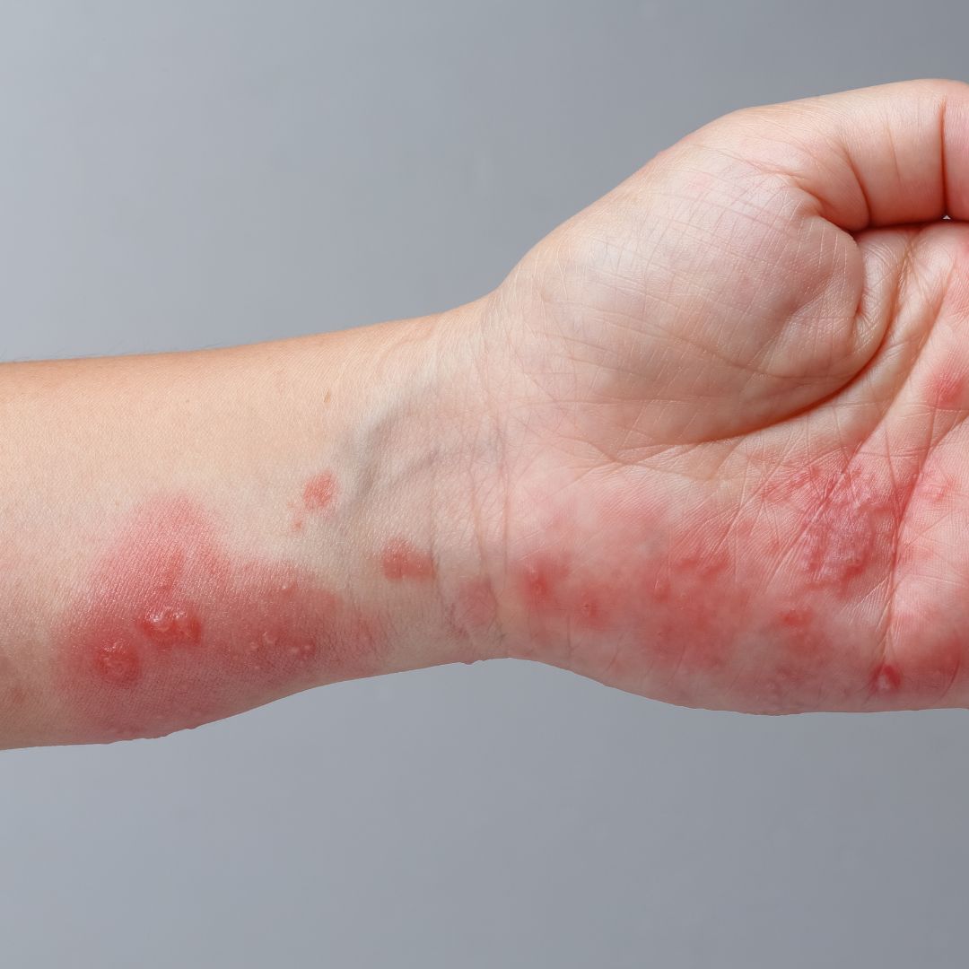 Dermnet Scabies Dermnet Scabies