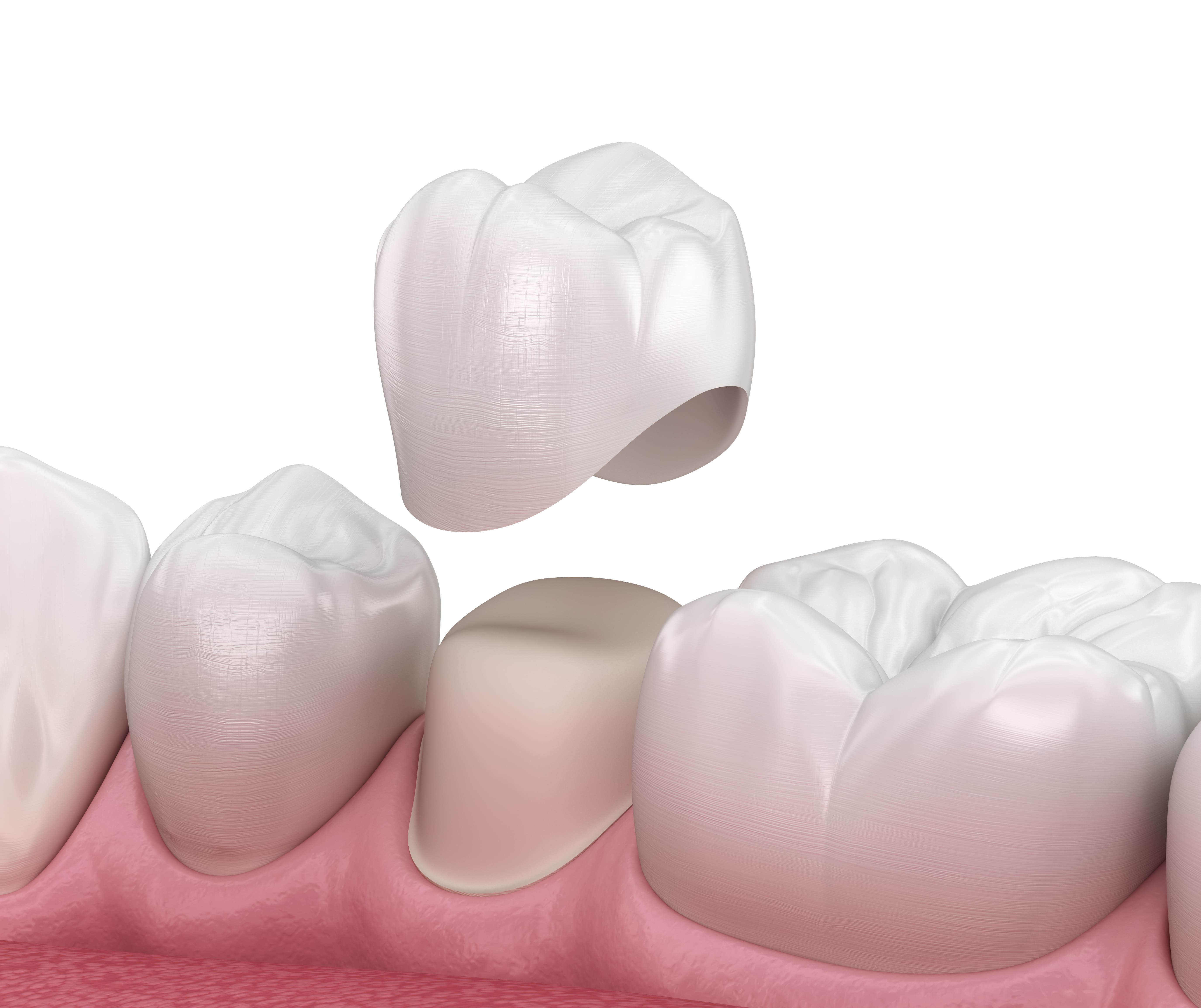 Dental Crown Cement Walgreens - peg1qm2