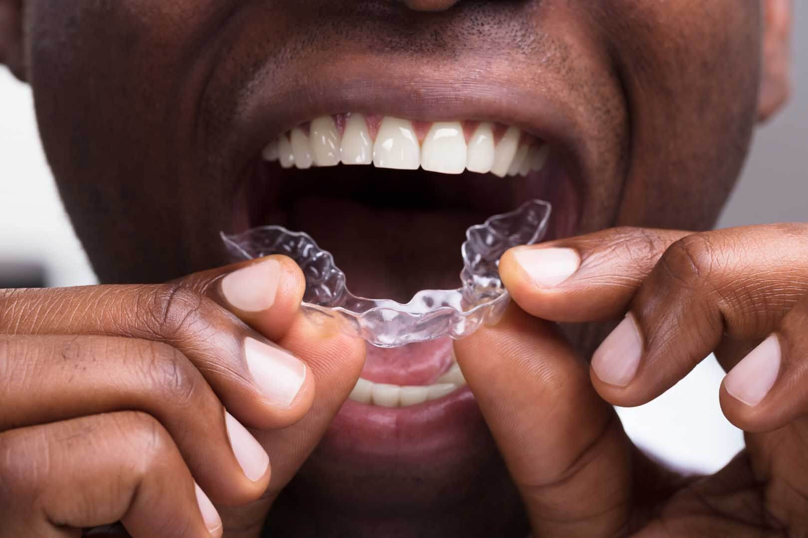 Occlusal & Sports Guards