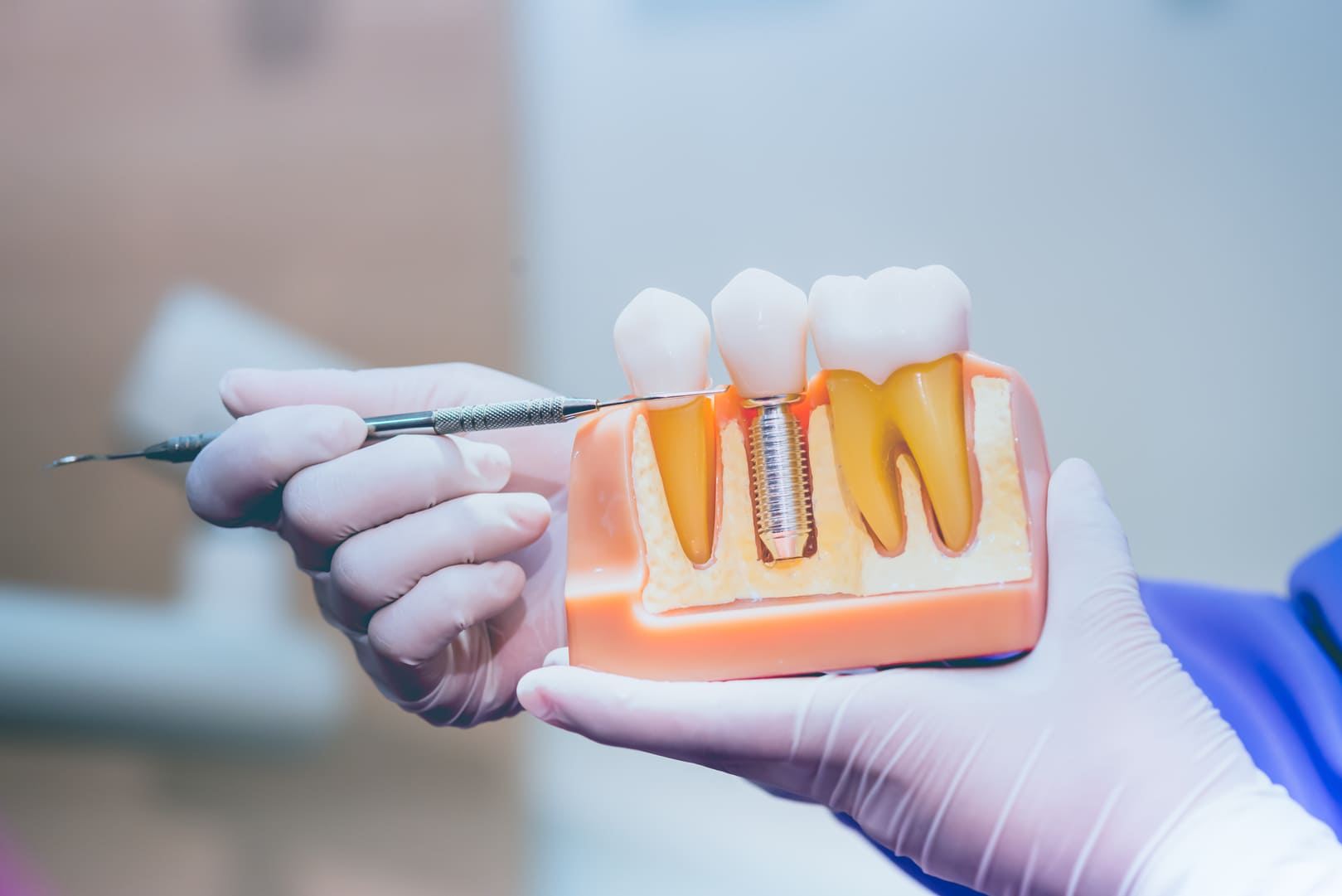 Zirconia Dental Implants