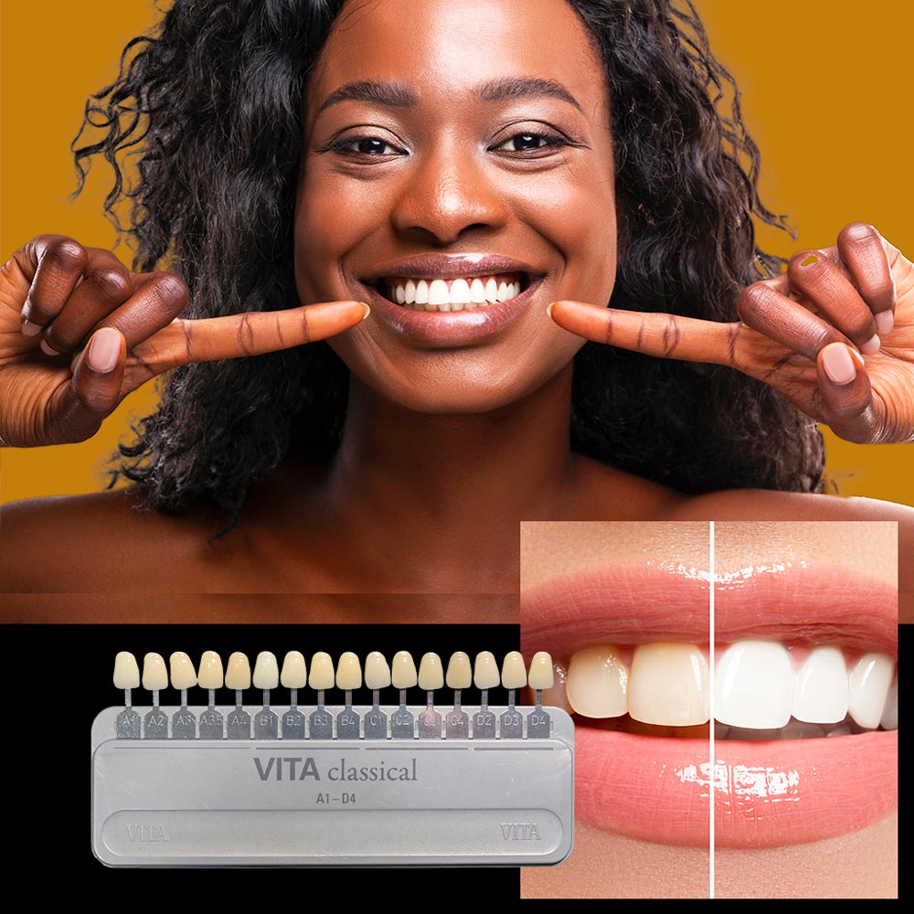 Teeth Whitening in Selly Oak Cosmetic Dentisty Harborne Lane Dental