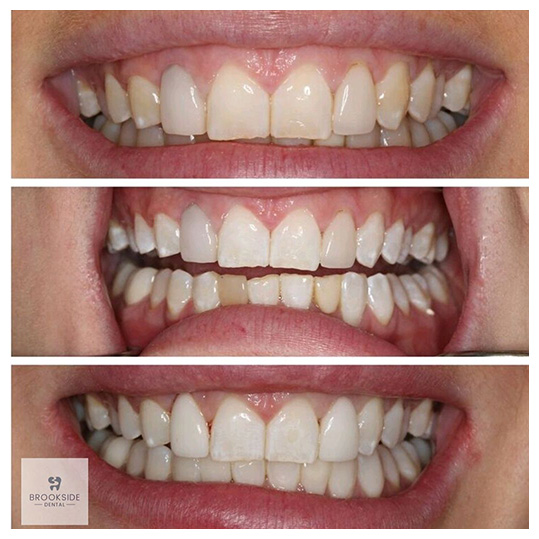Teeth whitening at Brookside Dental in Market Harborough Teeth