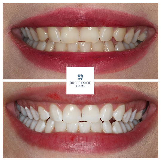 Teeth whitening at Brookside Dental in Market Harborough Teeth