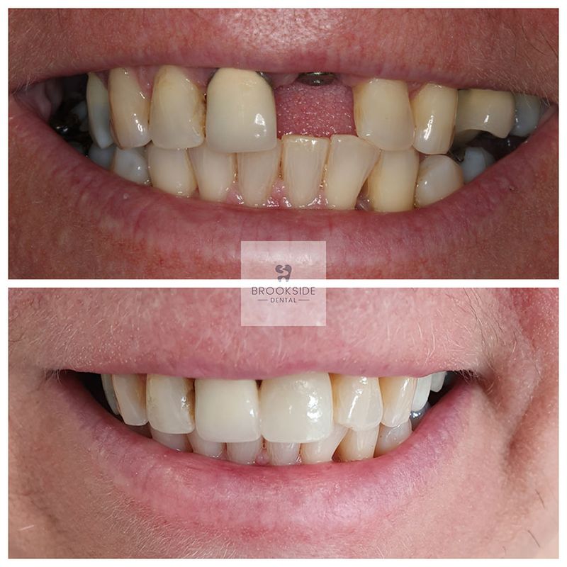 The best dental implants in Market Harborough Replace missing teeth