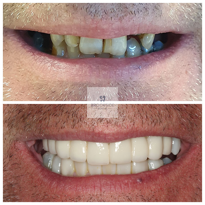 The best dental implants in Market Harborough Replace missing teeth