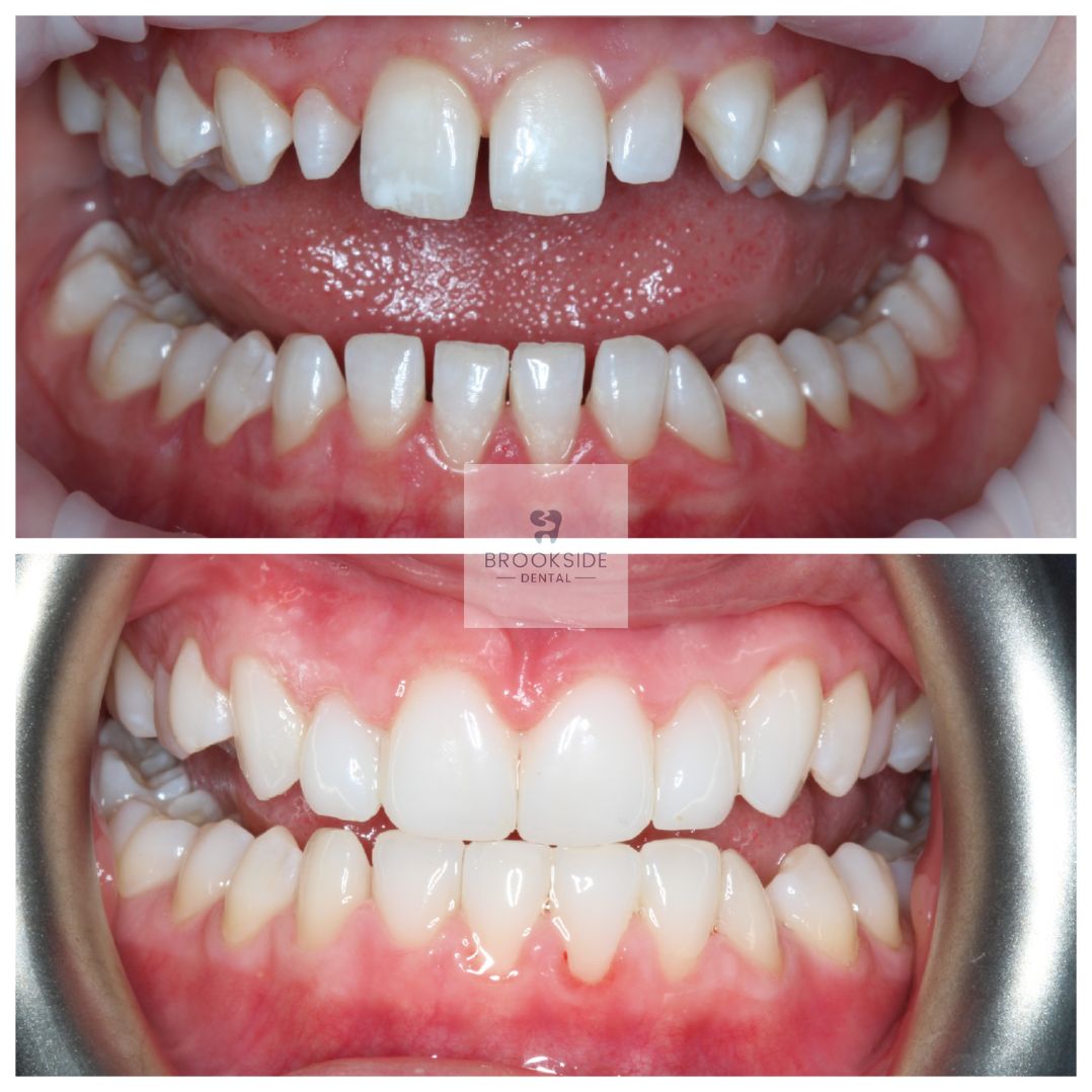 Professional veneers in Market Harborough Fix a broken tooth, shape