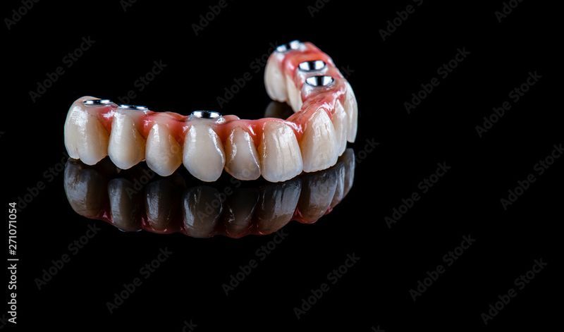 Full arch dental implants near me