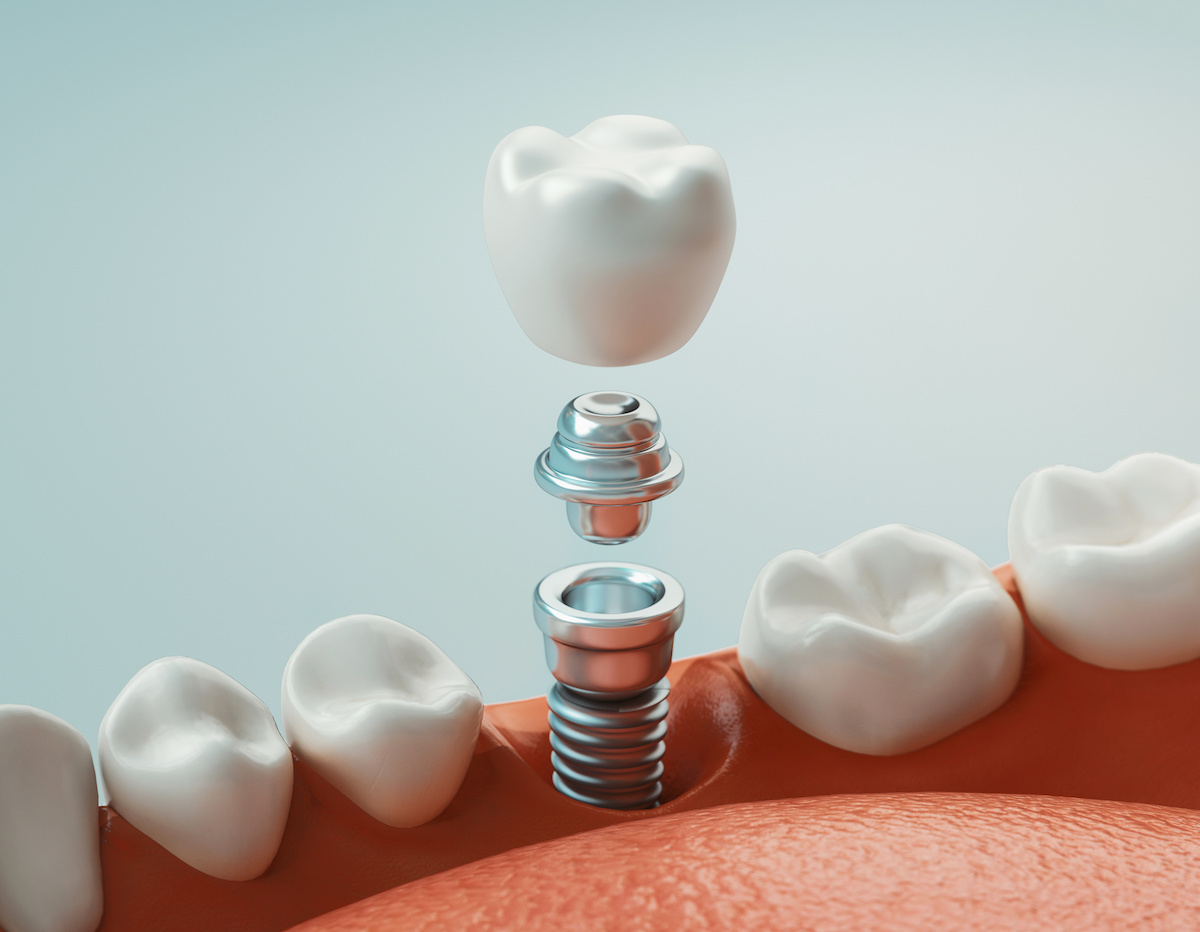 Dental Implants in Scottsdale, AZ Scottsdale Perfect Smiles