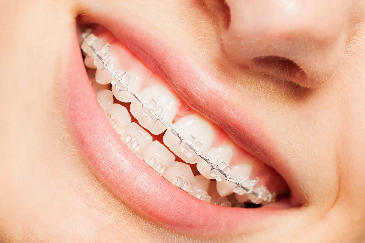 Ceramic Braces In Lawrenceville, GA Foster Orthodontics