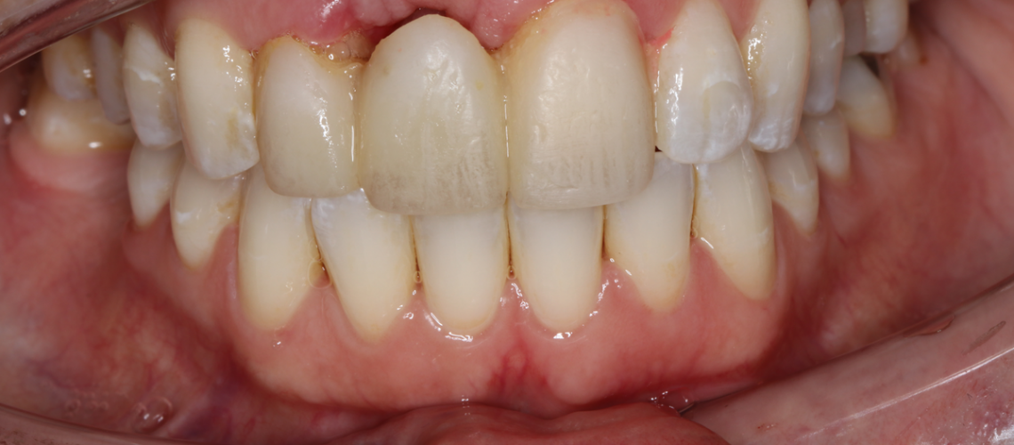 Moving Denture Bone Loss And Bone Points Gums By Gohel
