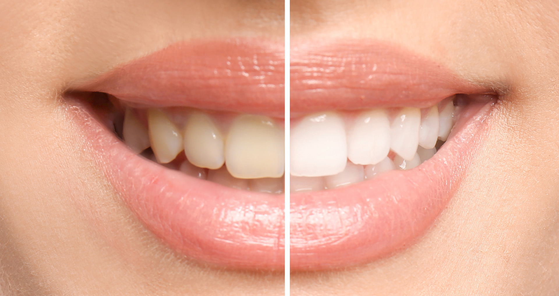 Teeth Whitening at Azure Dental in Colleyville