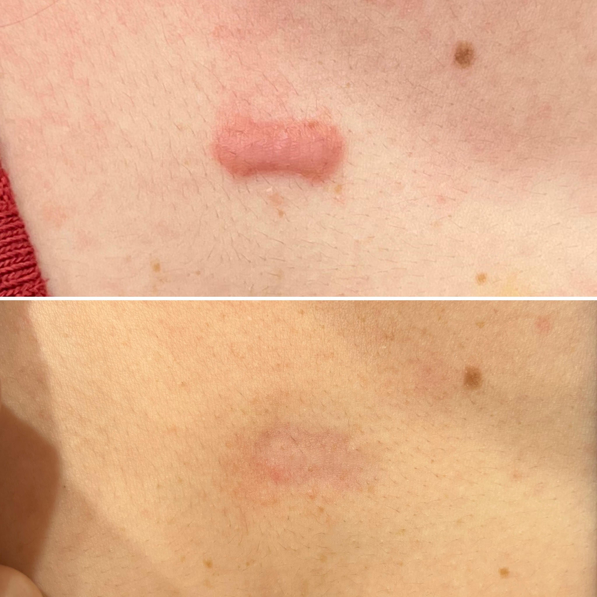 Keloid Scarring GMC Cosmedical