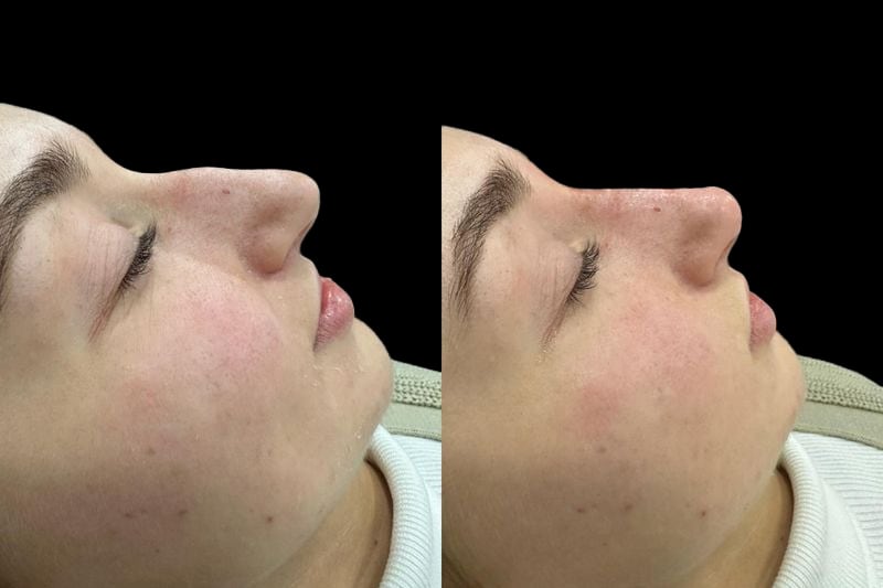 Non-surgical rhinoplasty before and after