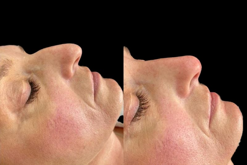 Non-surgical rhinoplasty before and after
