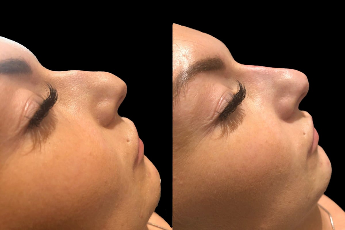 15 min nose job results