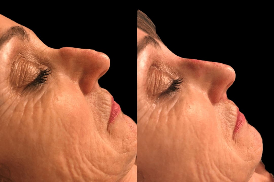 15 min nose job results