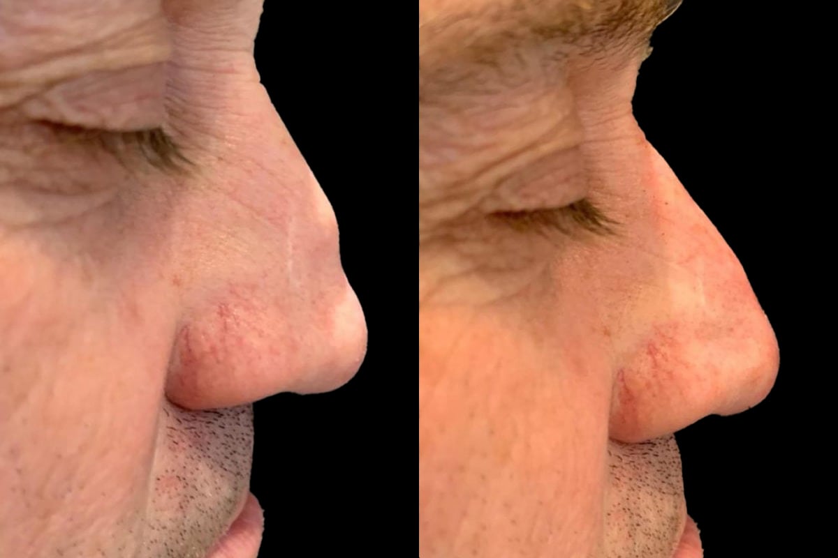 Non-surgical rhinoplasty before and after