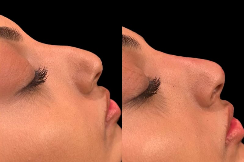 Non-surgical rhinoplasty before and after