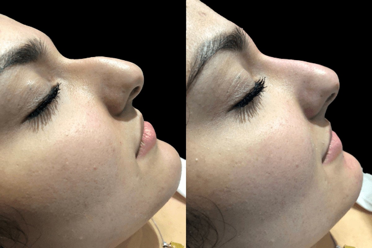 Non-surgical nose job London
