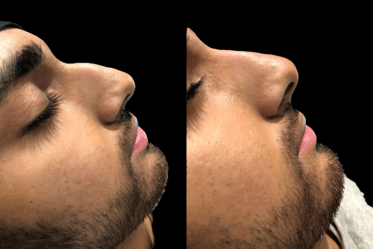 Non-surgical nose job Birmingham
