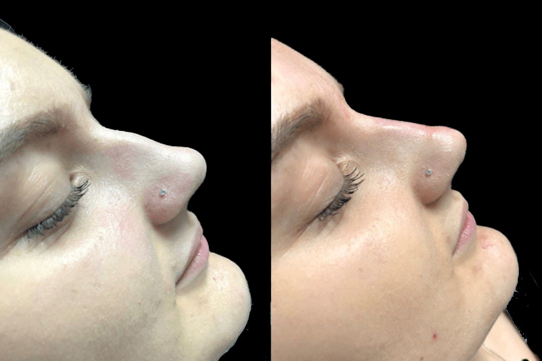 Non surgical nose jobs near me