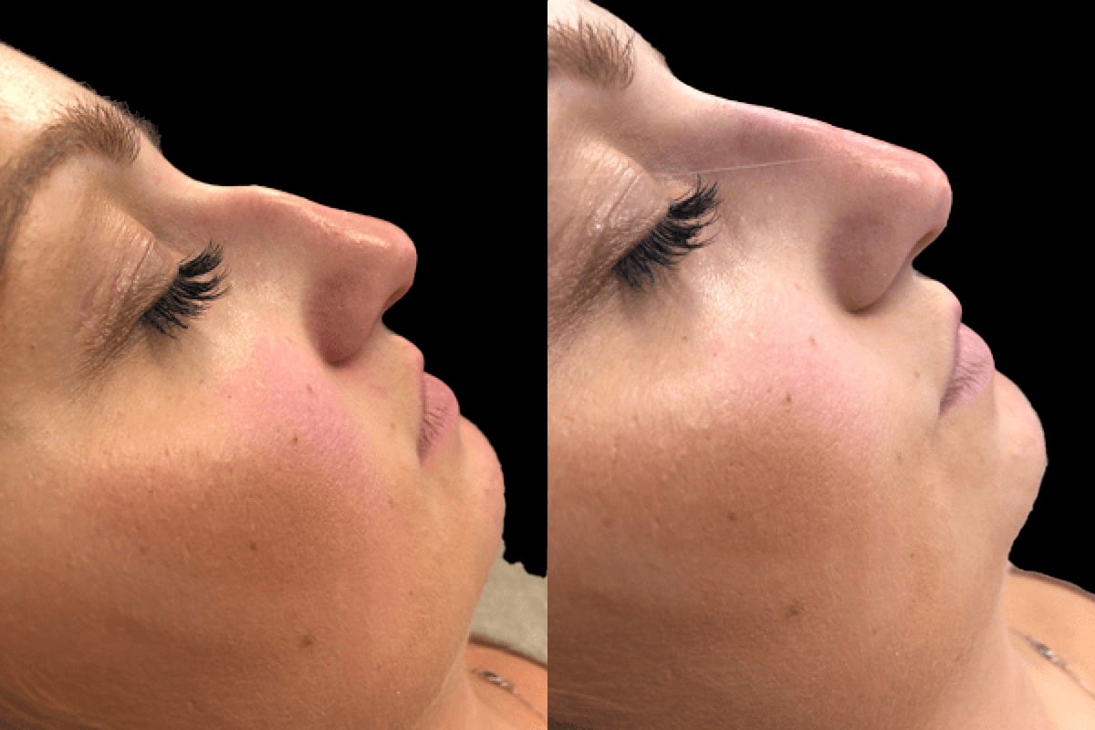 Liquid nose job cost