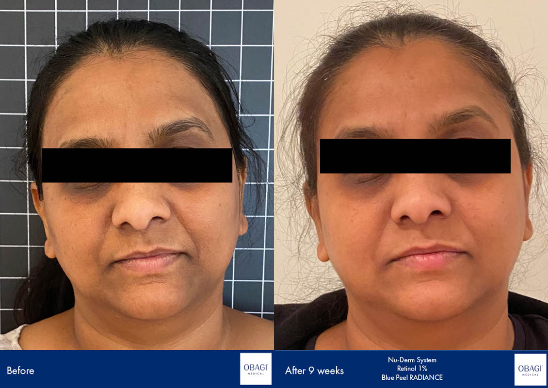 Non Surgical Nose Job Harley Street London AL Aesthetics